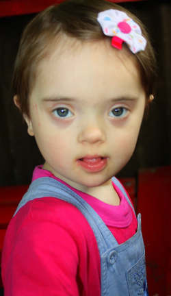 down-syndrome